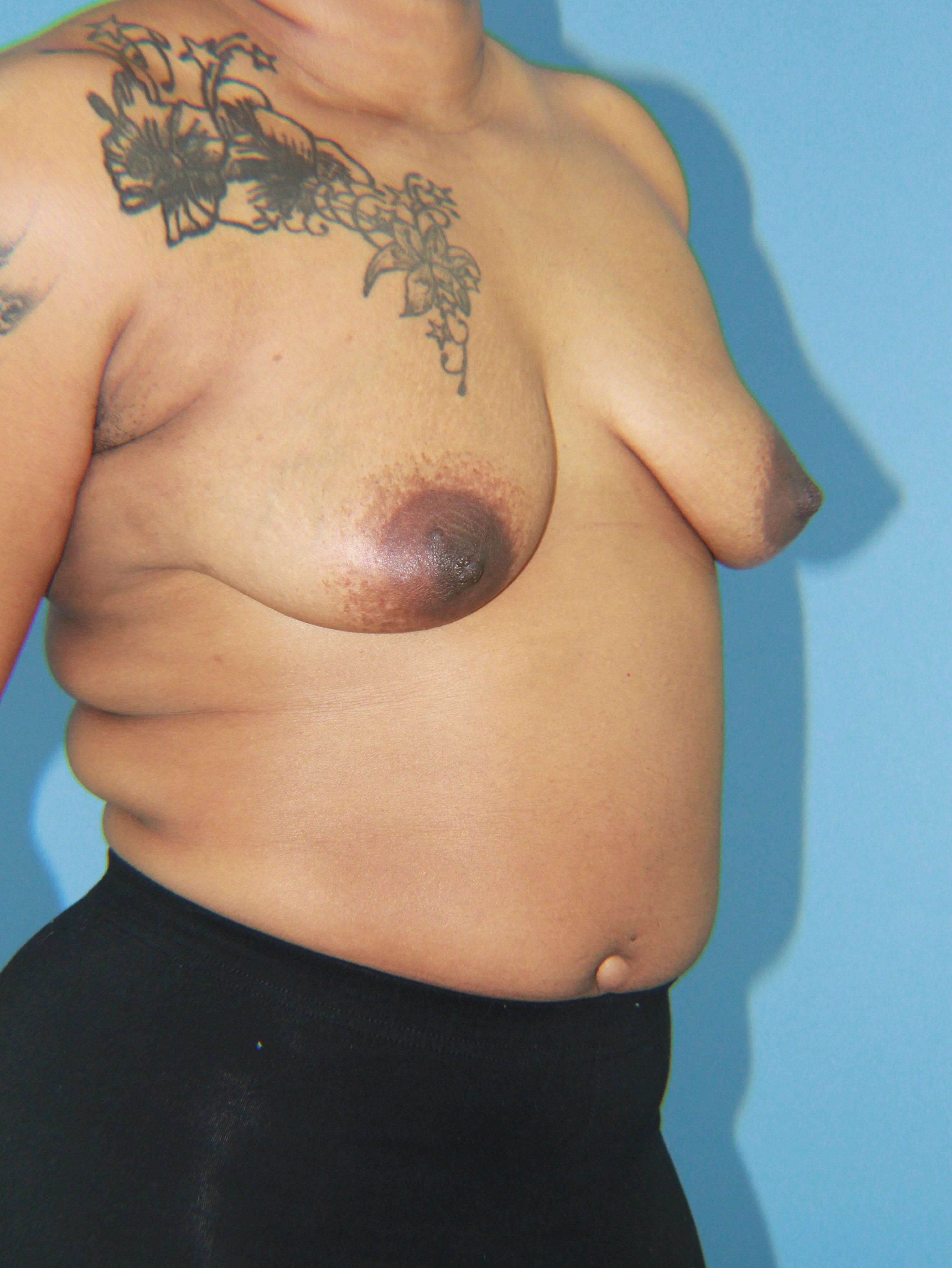 Breast Augmentation + Lift
