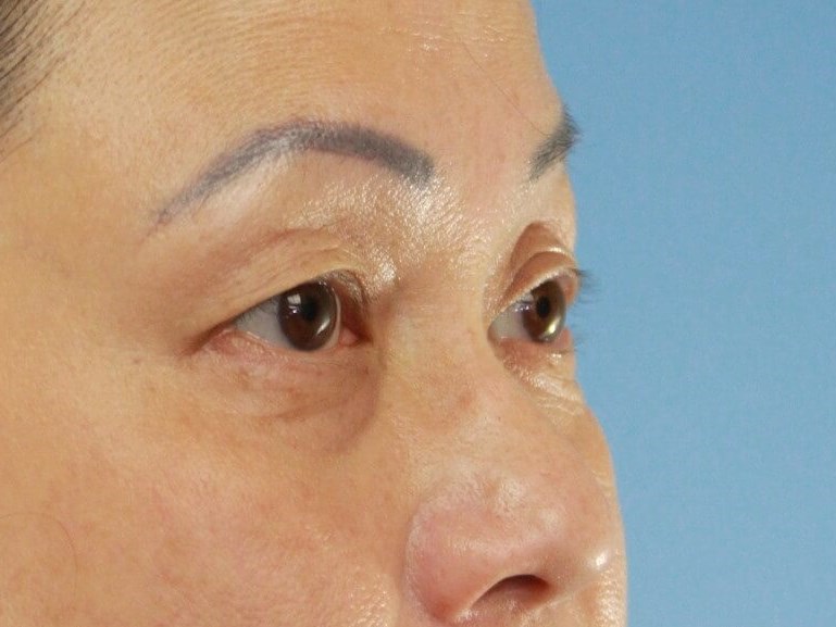 Eyelid Surgery real patient case photo