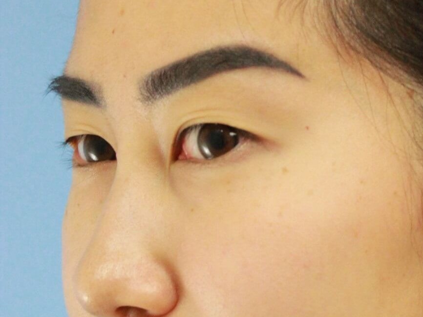 Asian Eyelid Surgery real patient case photo