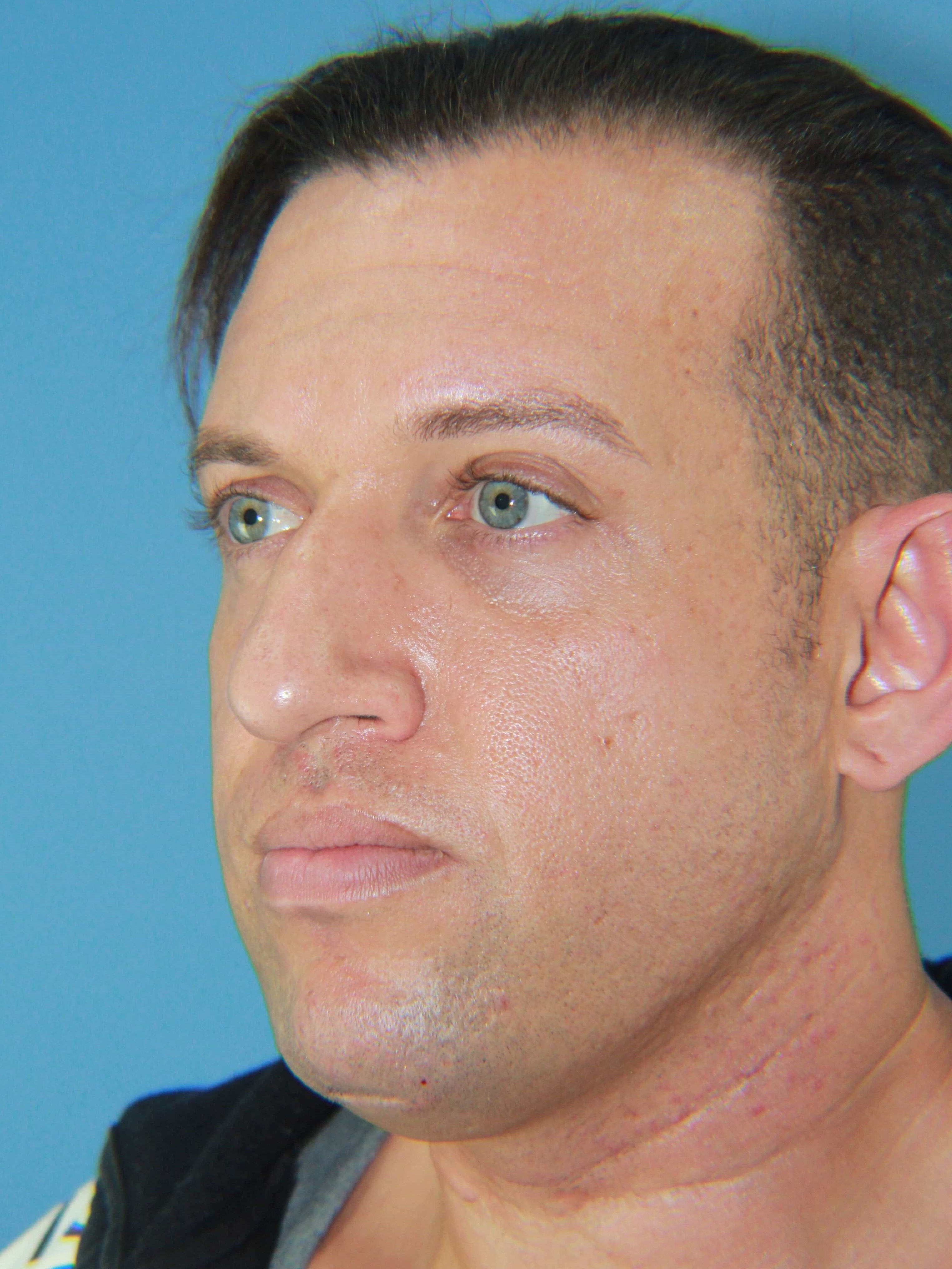 Male Rhinoplasty