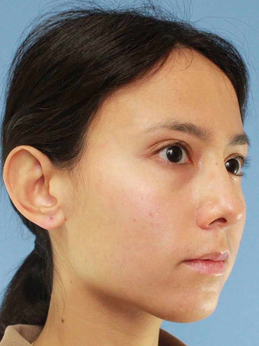 Ear Surgery real patient case photo