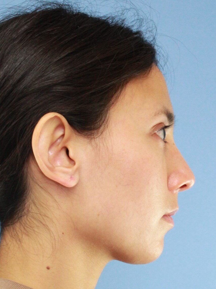 Ear Surgery real patient case photo