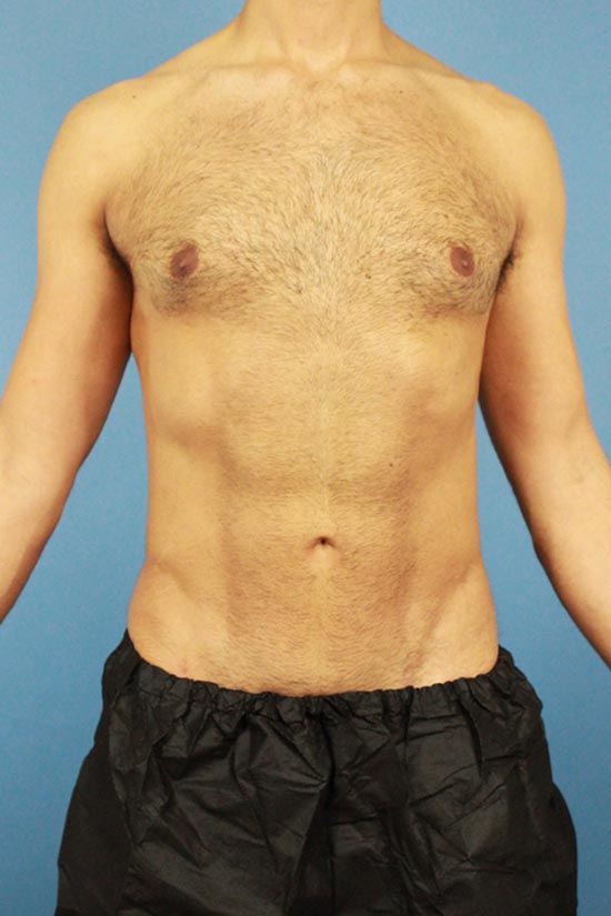 Male Hi-Def Liposuction