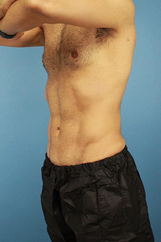Male Hi-Def Liposuction