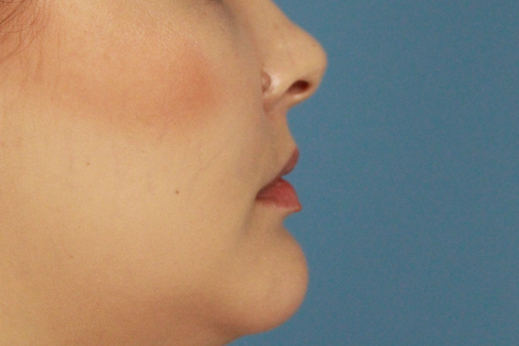 Lip Fillers real patient case photo