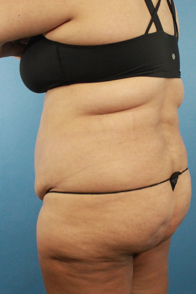 Liposuction