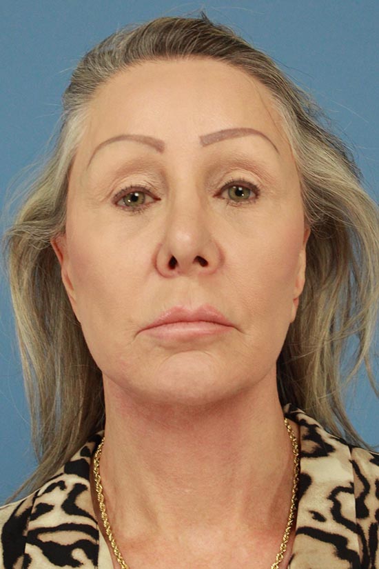 Facelift and Neck Lift