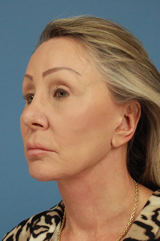 Facelift and Neck Lift