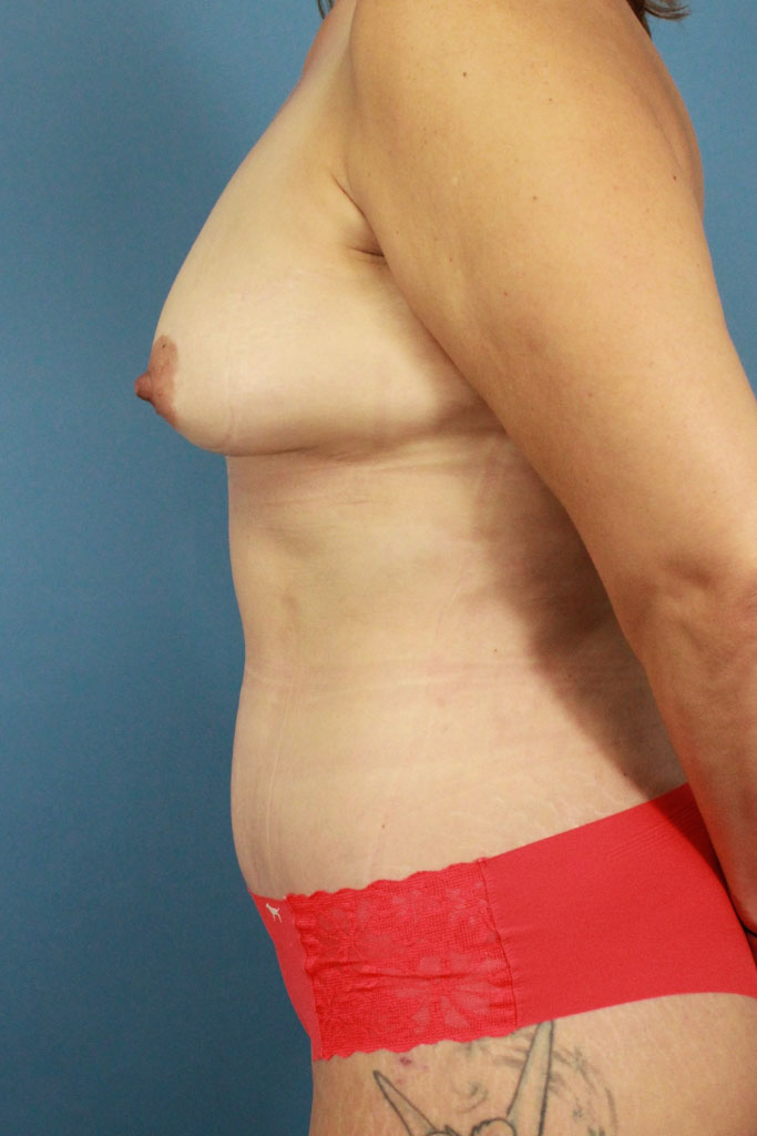 Fat Grafting to the Breasts real patient case photo
