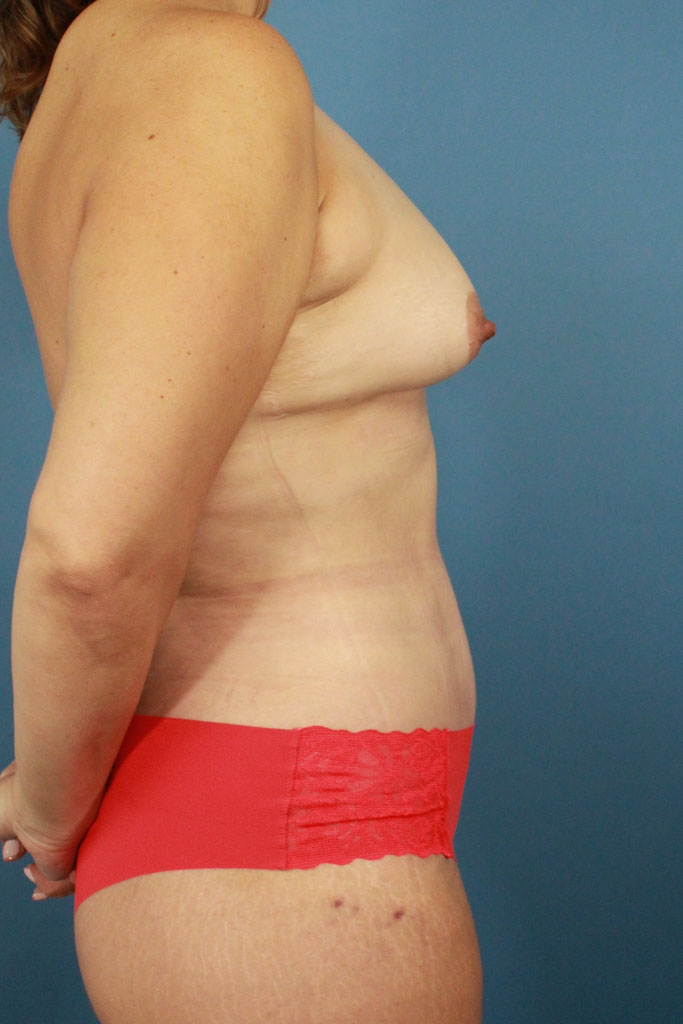 Fat Grafting to the Breasts real patient case photo