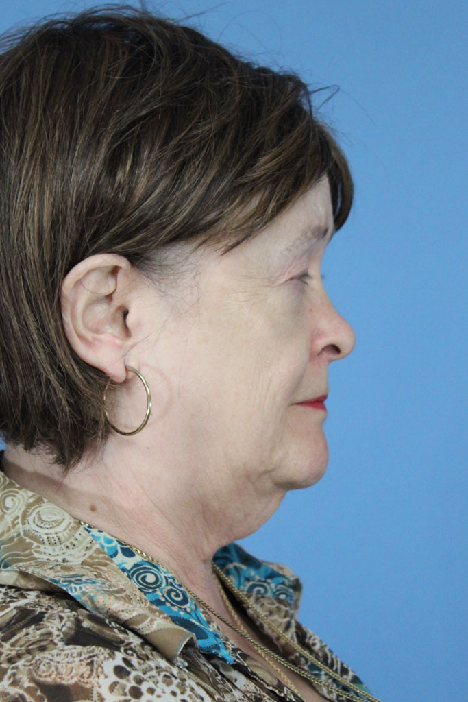 Facelift and Neck Lift real patient case photo