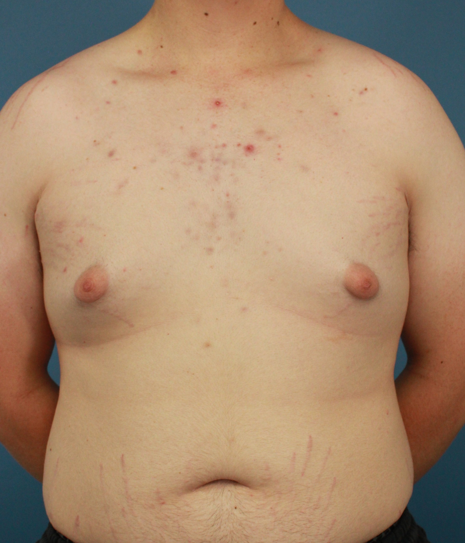 Gynecomastia