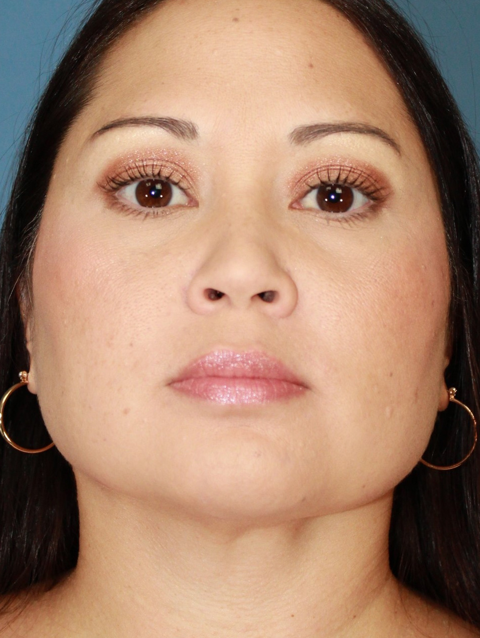 Buccal Fat Removal and V Line real patient case photo