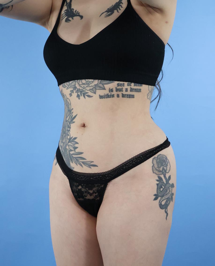 Liposuction