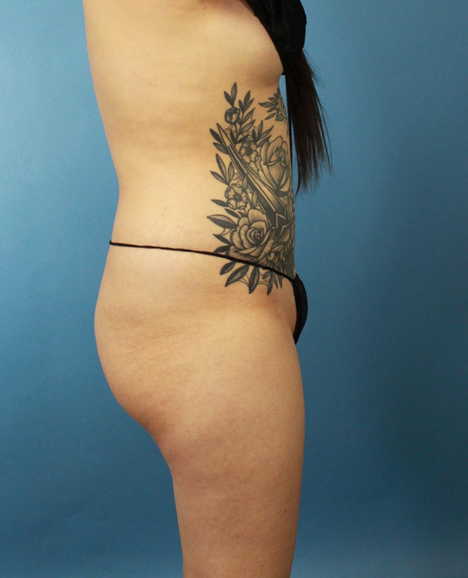 Liposuction