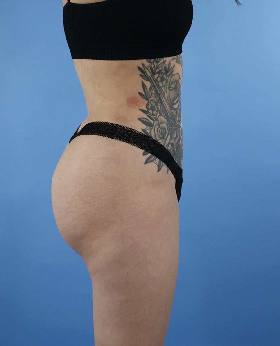Liposuction