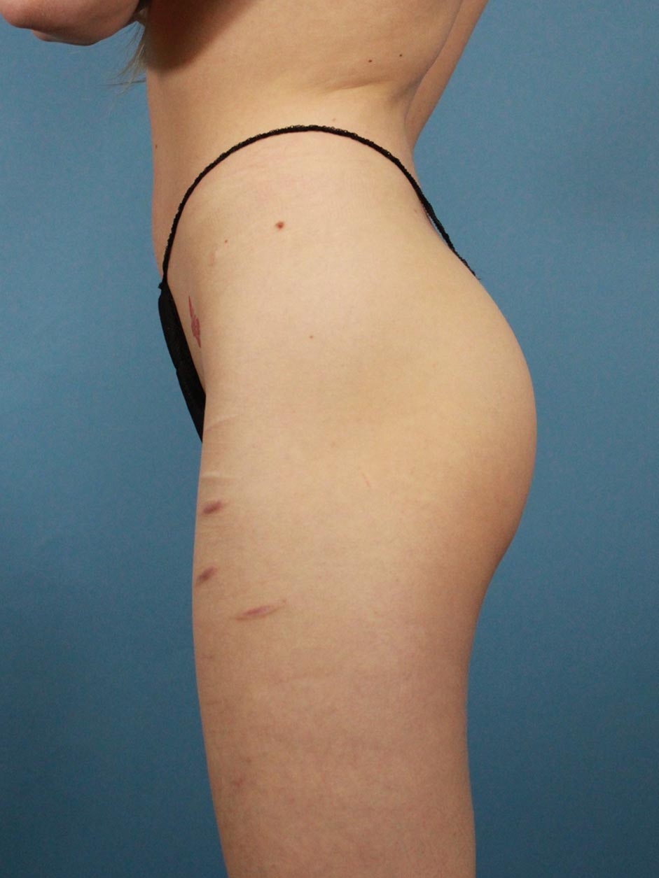 Butt Implants real patient case photo