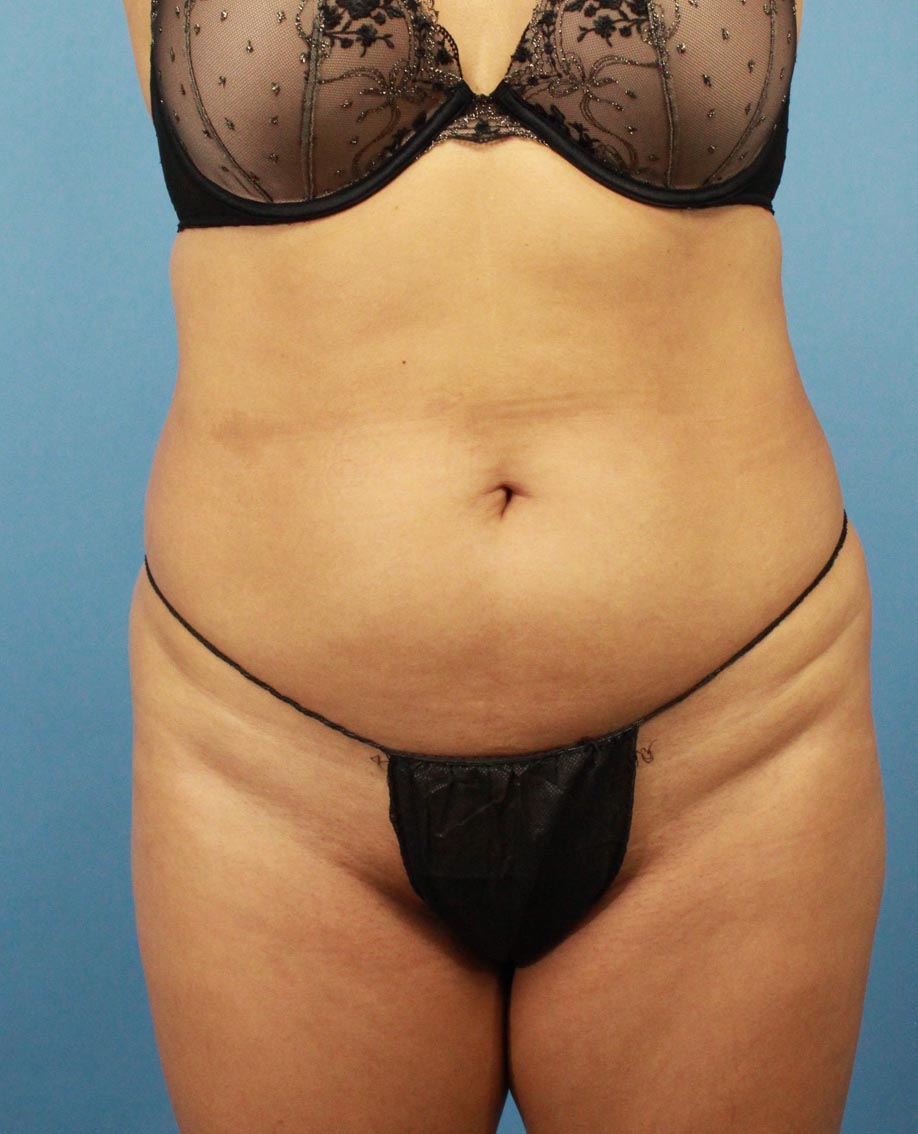 Liposuction real patient case photo