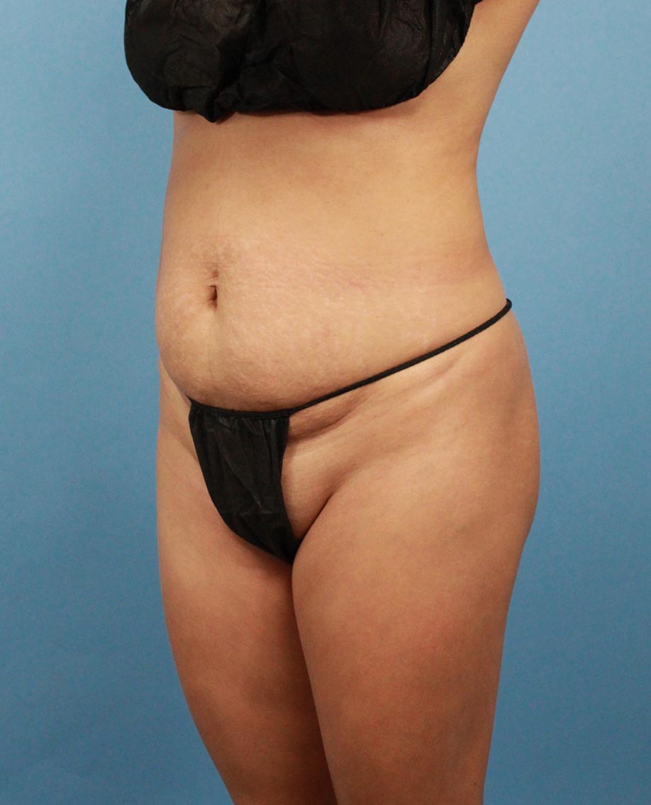 Tummy Tuck real patient case photo