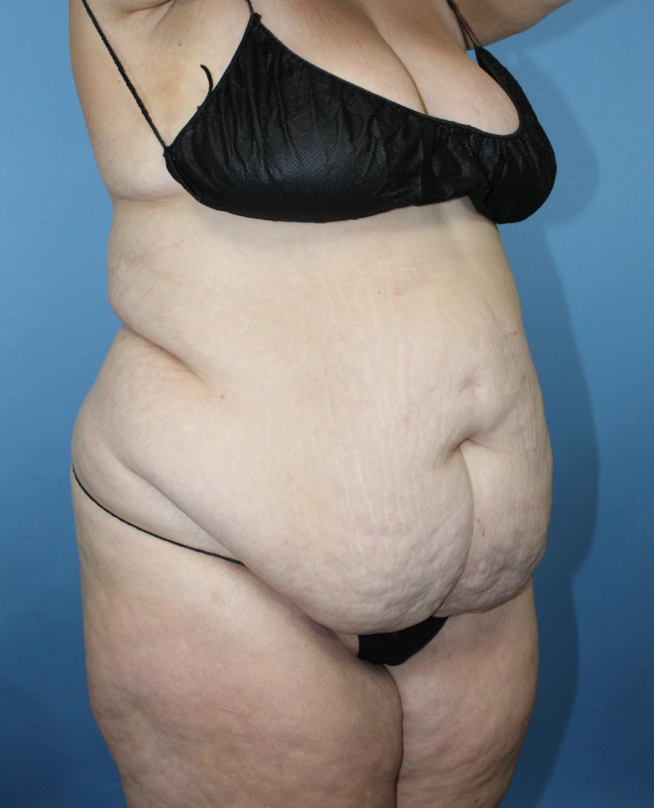 After Weight Loss Surgery