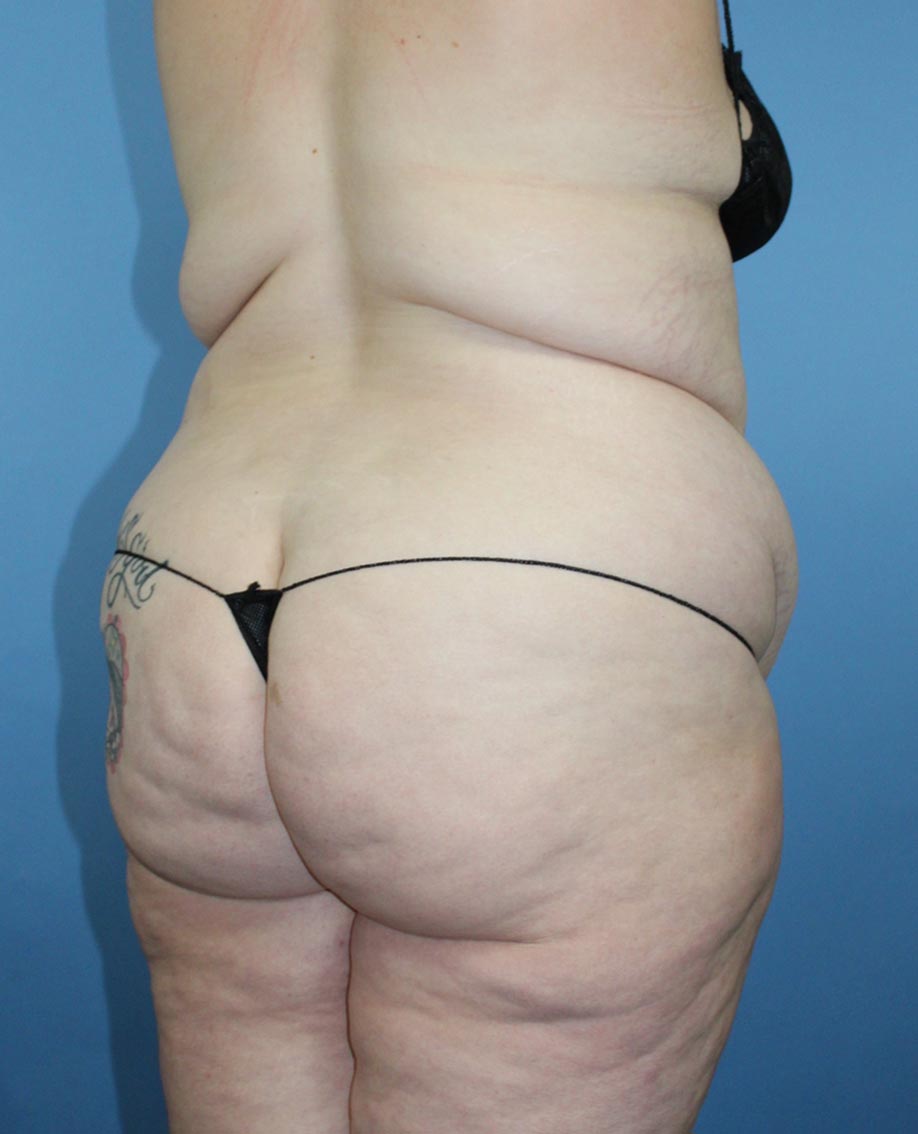 Liposuction real patient case photo Liposuction real patient case photo