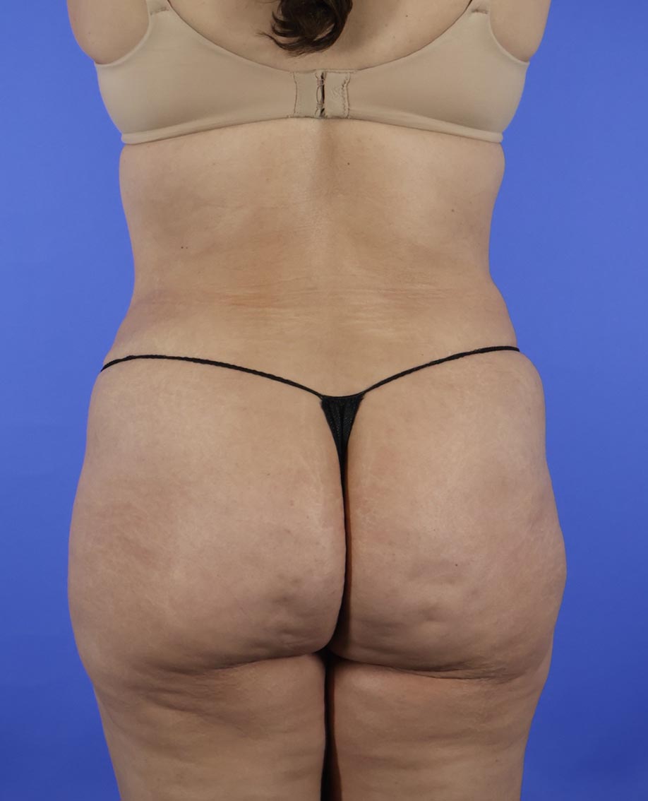 Liposuction real patient case photo Liposuction real patient case photo