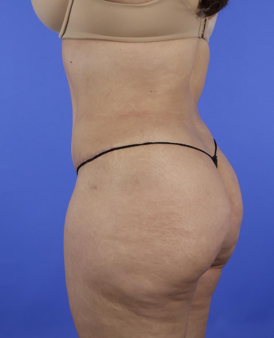 Liposuction real patient case photo Liposuction real patient case photo