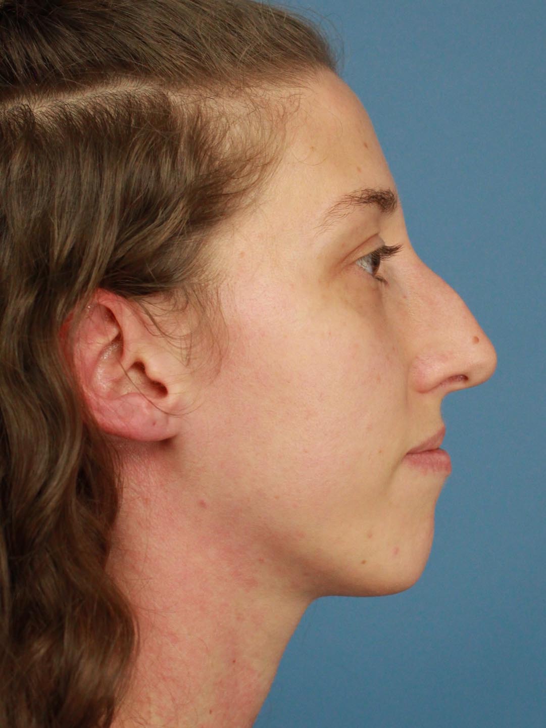 Rhinoplasty