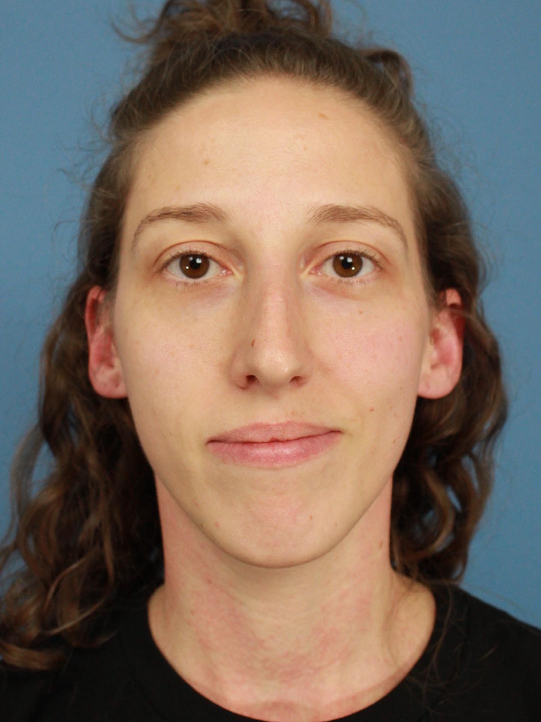 Rhinoplasty