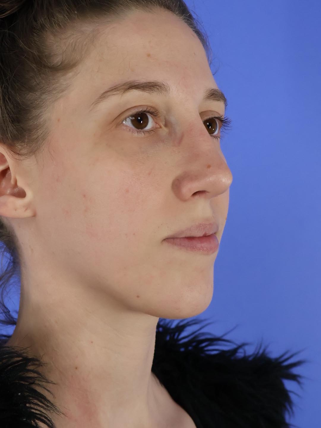 Rhinoplasty