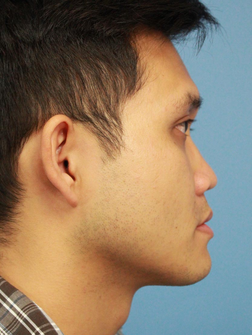Male Rhinoplasty real patient case photo