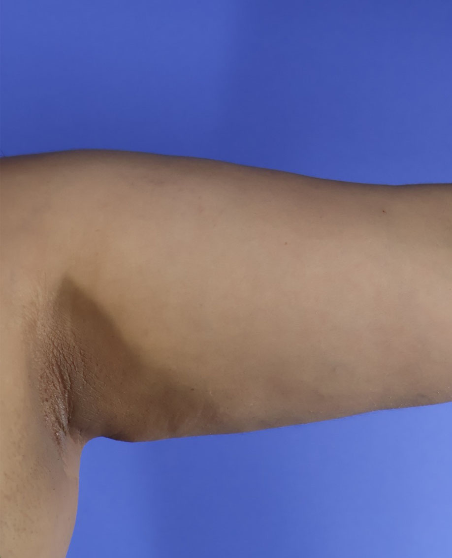 Arm Liposuction real patient case photo