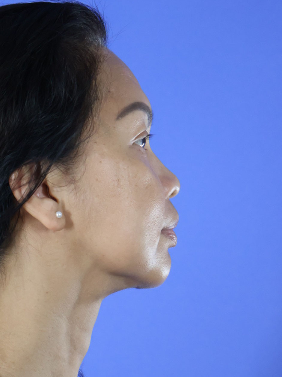 Chin Liposuction real patient case photo