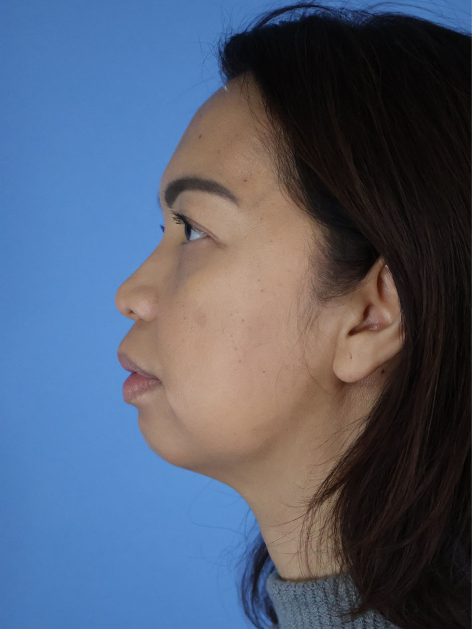 Chin Liposuction real patient case photo