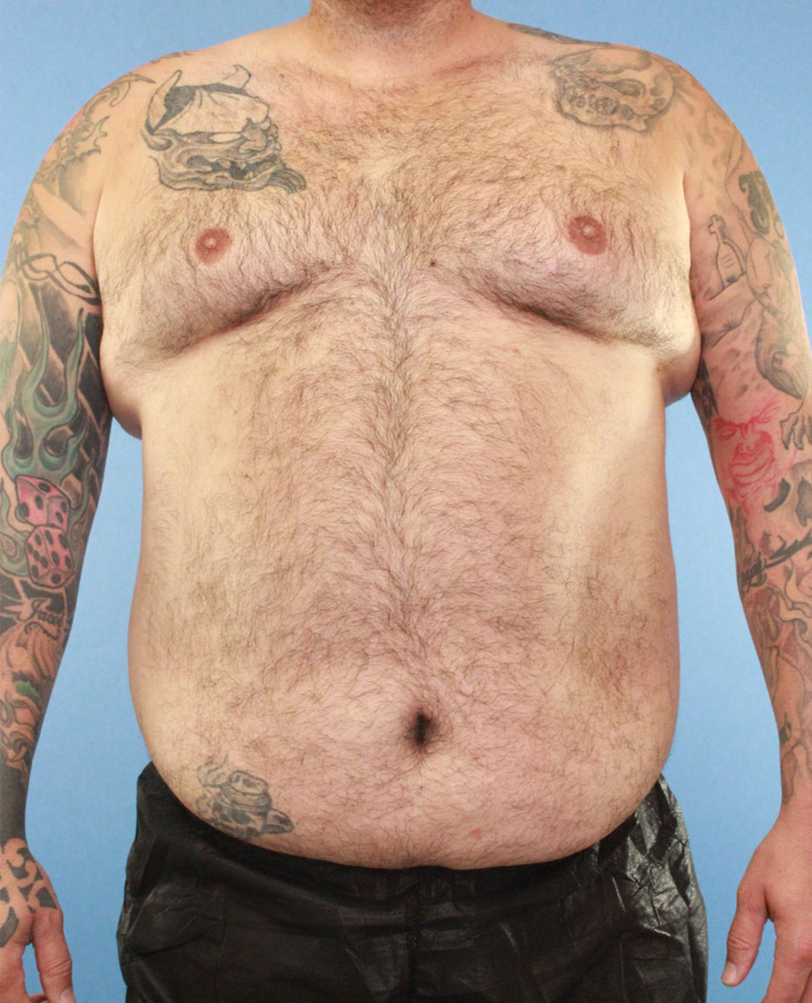 Male Tummy Tuck real patient case photo