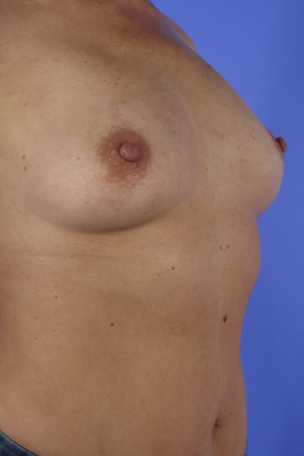 Breast Augmentation real patient case photo