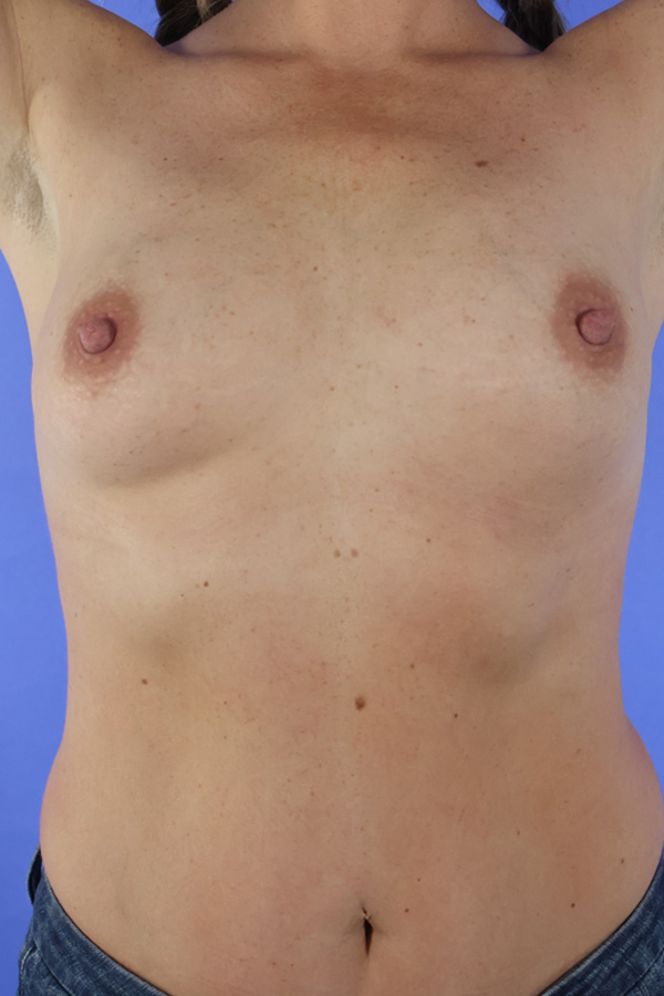 Breast Augmentation real patient case photo