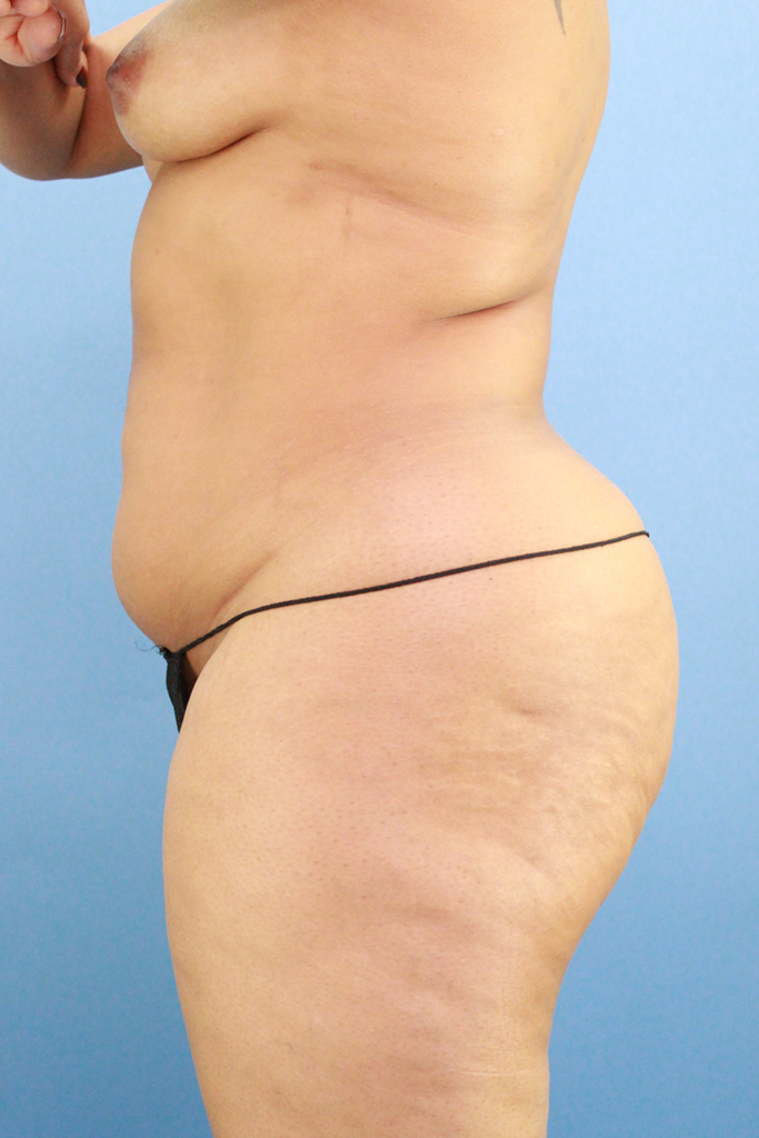 Liposuction real patient case photo