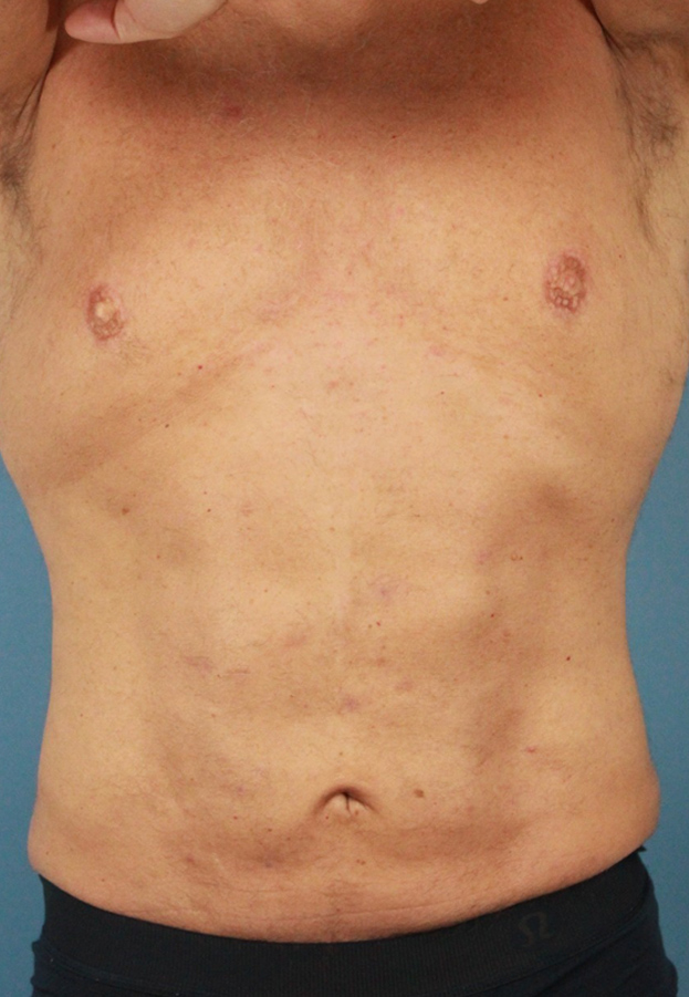 Male Hi-Def Liposuction real patient case photo