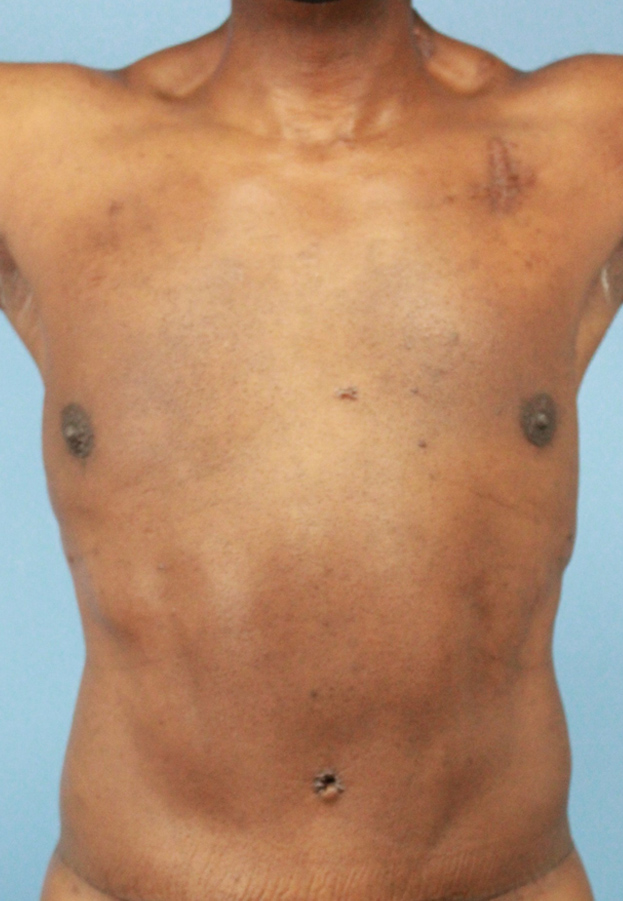 Male Hi-Def Liposuction real patient case photo