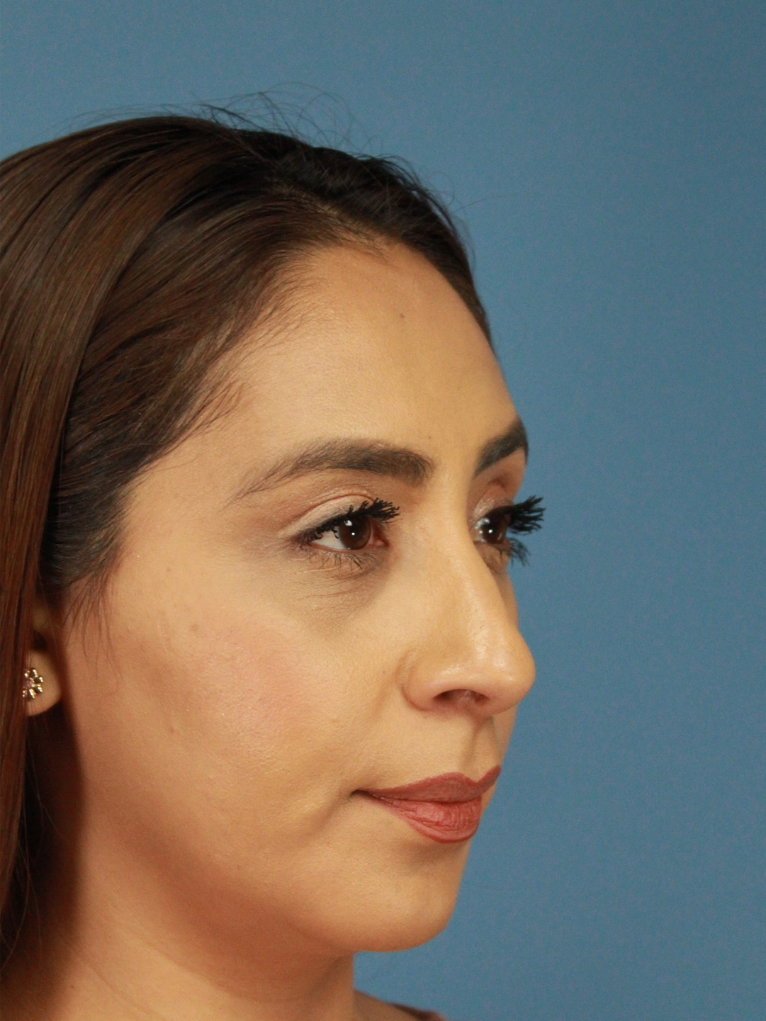 Rhinoplasty real patient case photo
