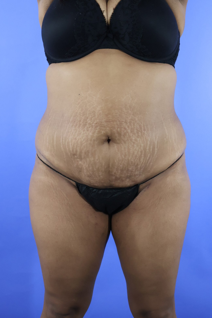 Liposuction real patient case photo Liposuction real patient case photo