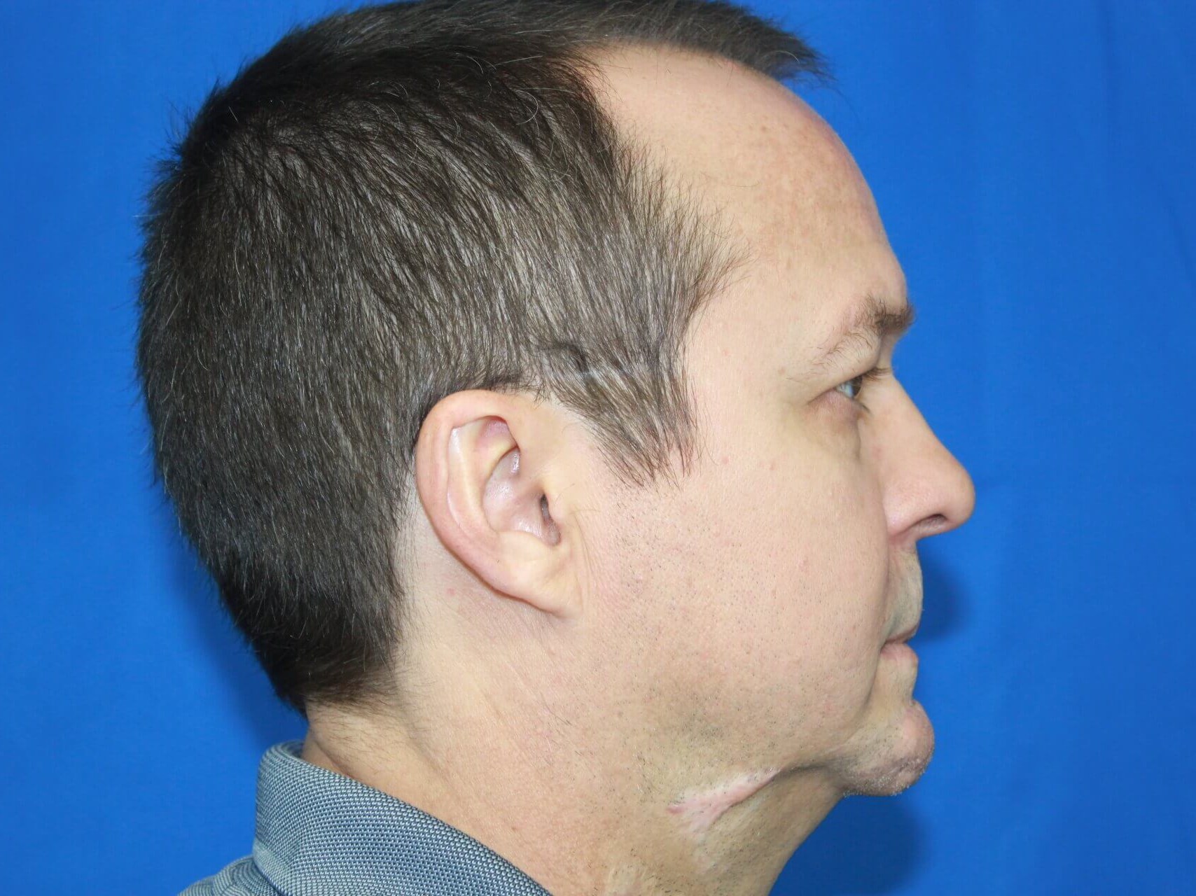 Scar Reduction real patient case photo