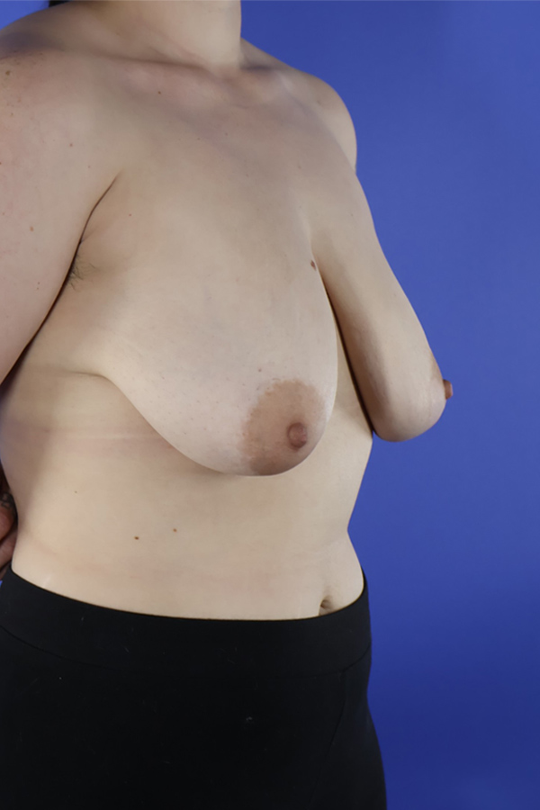 Breast Augmentation + Lift real patient case photo