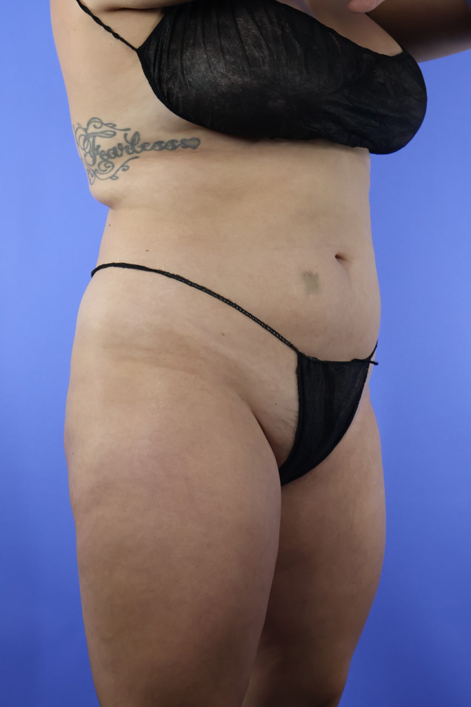 Brazilian Butt Lift real patient case photo