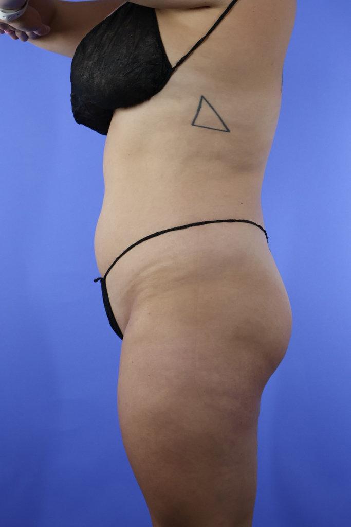Brazilian Butt Lift real patient case photo
