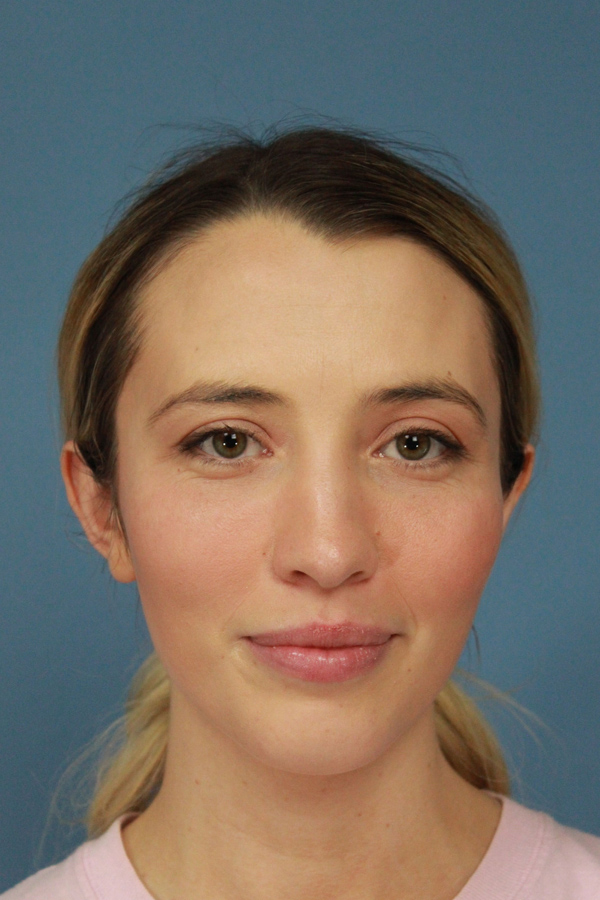 Brow Lift real patient case photo