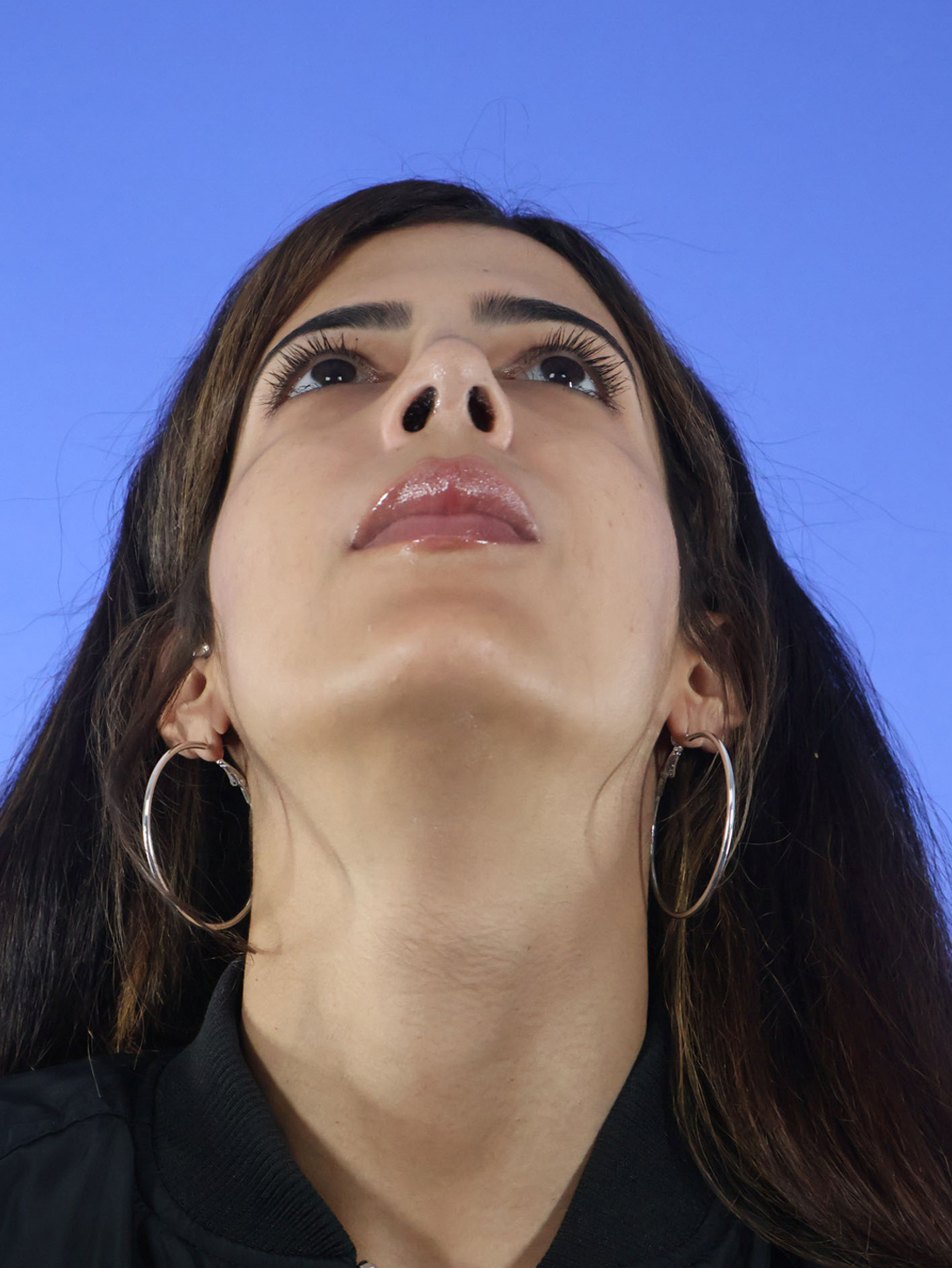 Rhinoplasty real patient case photo Rhinoplasty real patient case photo