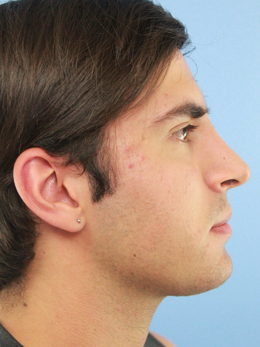 Male Rhinoplasty real patient case photo