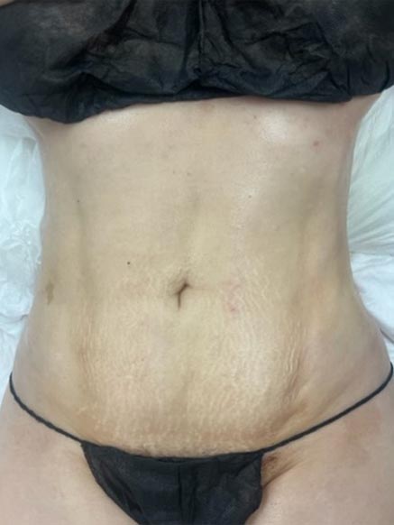 Lymphatic Drainage Massage real patient case photo